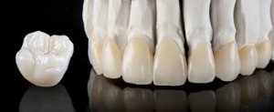 Crown n bridge in implants